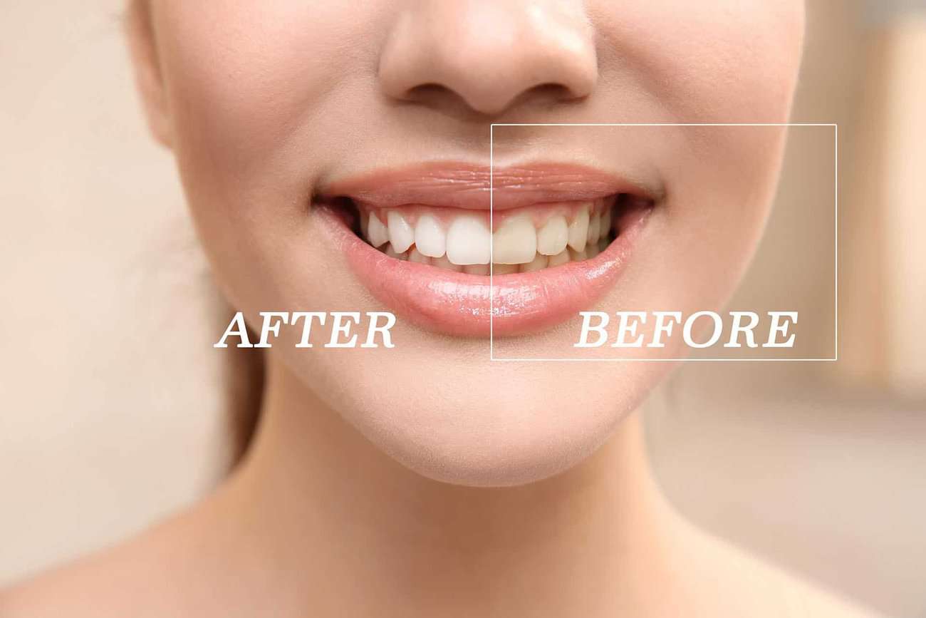 What Are the Most Effective Natural Teeth Whitening Methods You Can Try Tamworth?
