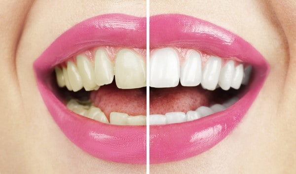 What Makes Ultima White Teeth Whitening Different Tamworth
