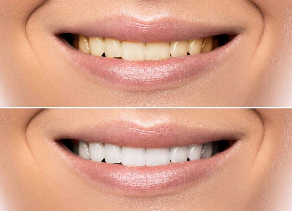 How Does Gum Disease Progress if Left Untreated Tamworth?
