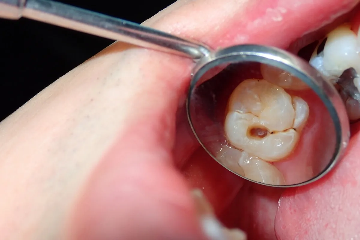 Why Do Teeth Crack? Common Causes to Know Tamworth