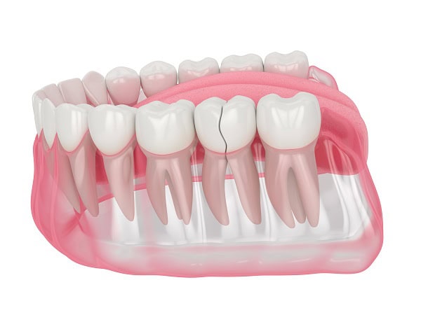 How Can You Manage Pain and Discomfort After a Root Canal Tamworth?