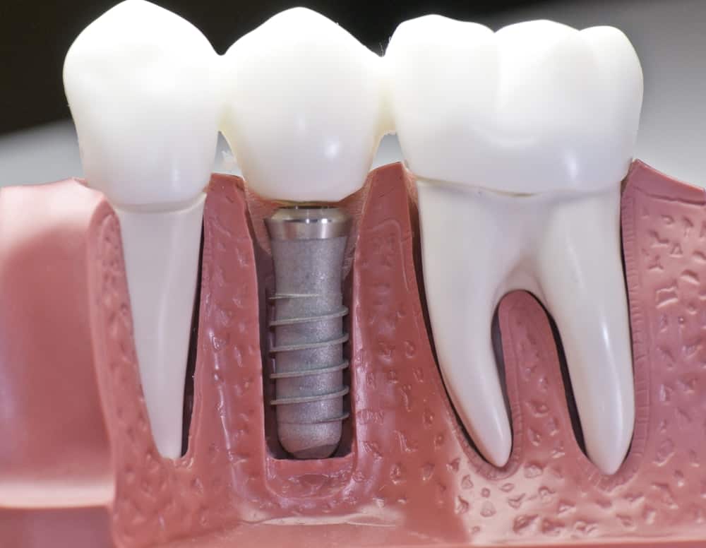 Common Misconceptions About Modern Dental Treatments Tamworth