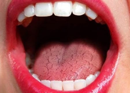 Common Causes of Dry Mouth (Xerostomia) Tamworth