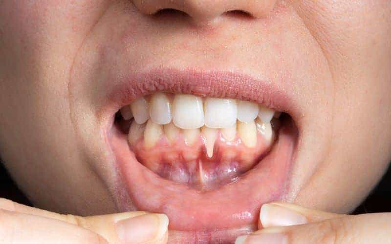 How Can Gum Disease Be Prevented Tamworth?
