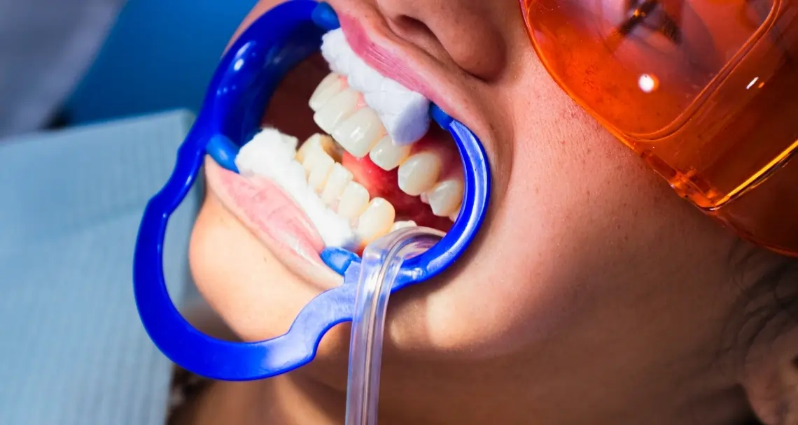 What Side Effects Can You Experience After Laser Teeth Whitening Tamworth?