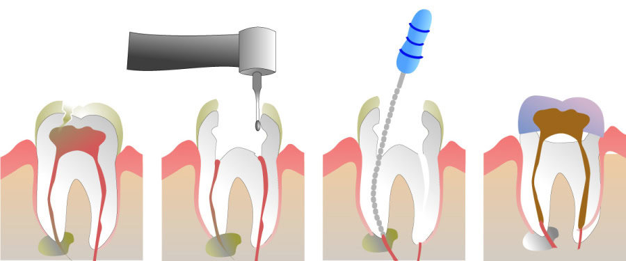 How Do You Properly Care for Your Teeth After a Root Canal Tamworth