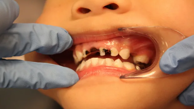 Tips for Keeping Your Child’s Baby Teeth Healthy and Strong Tamworth