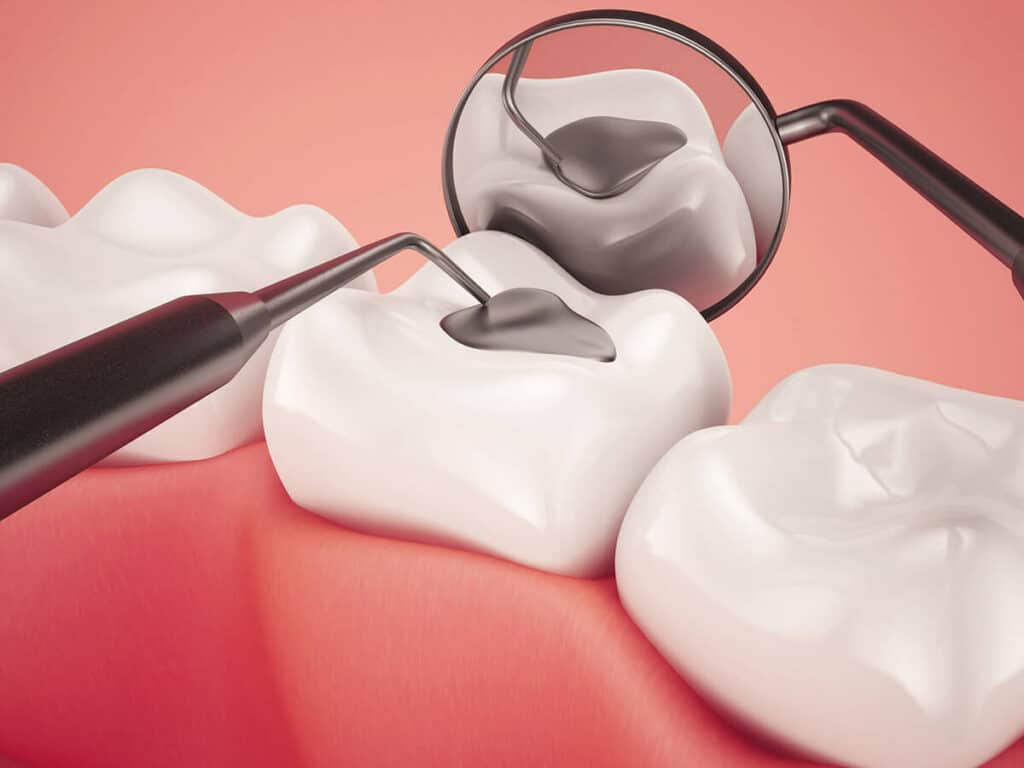 Fighting Cavities and Plaque Buildup Tamworth