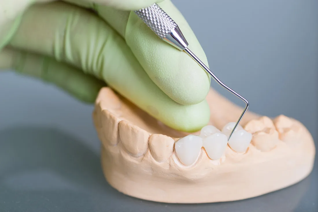 What Are the Different Types of Dental Crowns Available Tamworth?