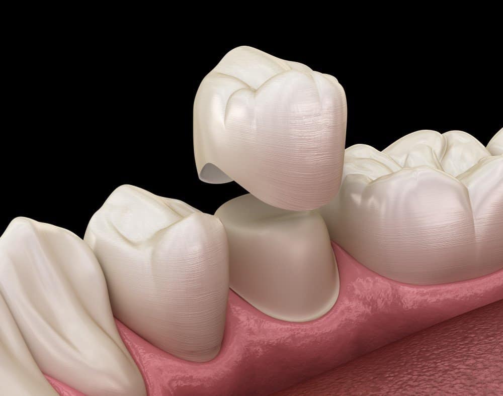 Teeth Whitening: Separating Facts from Fiction Tamworth