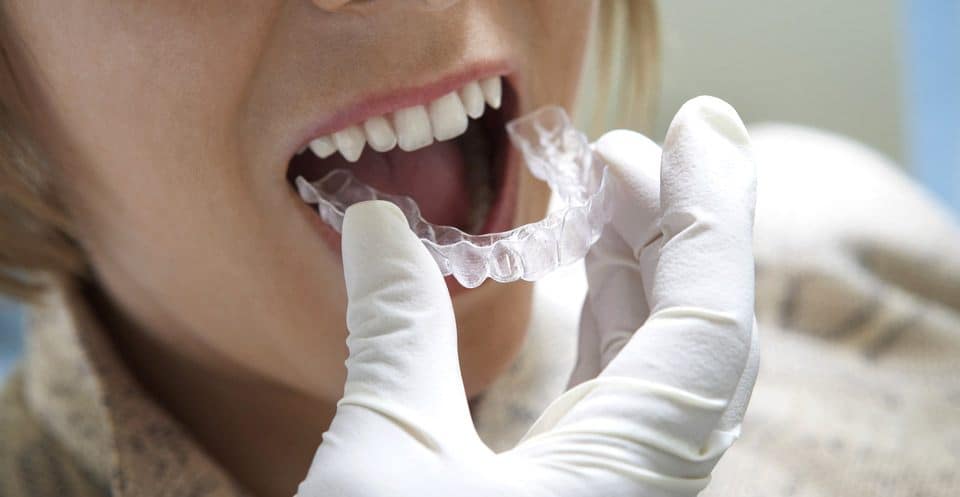 Can Bruxism Affect Your Sleep Quality Tamworth