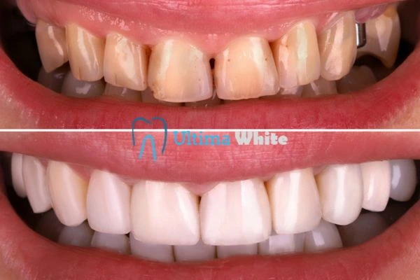 What Makes Instant Teeth Whitening Treatments So Popular Tamworth?