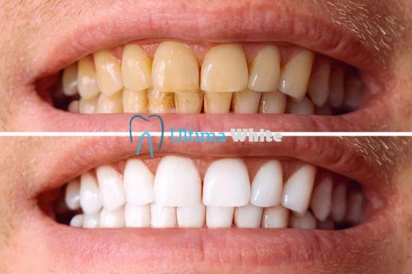 Stained Teeth and Persistent Bad Breath Tamworth